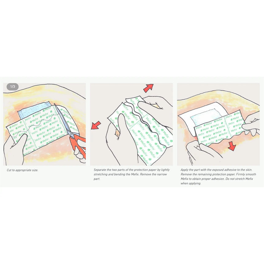 Mefix® Nonwoven Dressing Retention Tape, 2 Inch x 11 Yard Mefix®